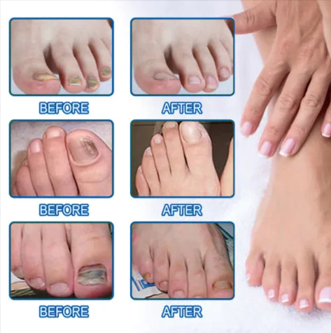 Nail Repair Adhesive Patches